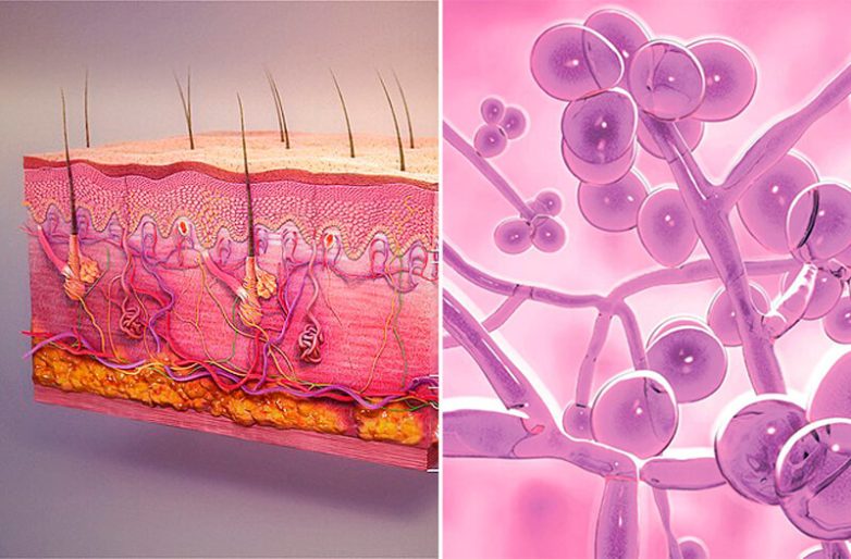 5 советов по лечению кожного кандидоза0